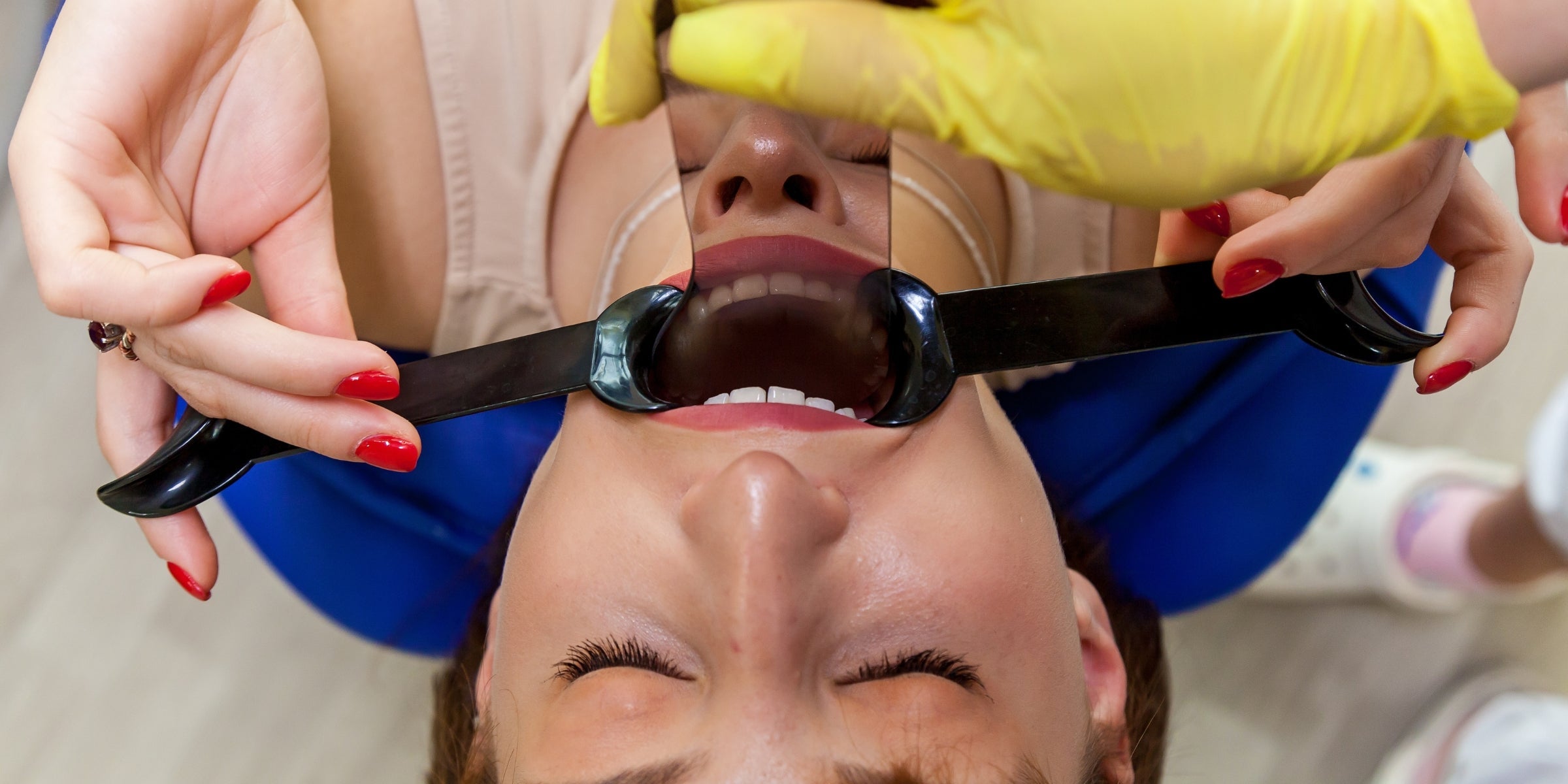 Soft Tissue Retractors: An Essential Tool for Dental Photography Dentiphoto