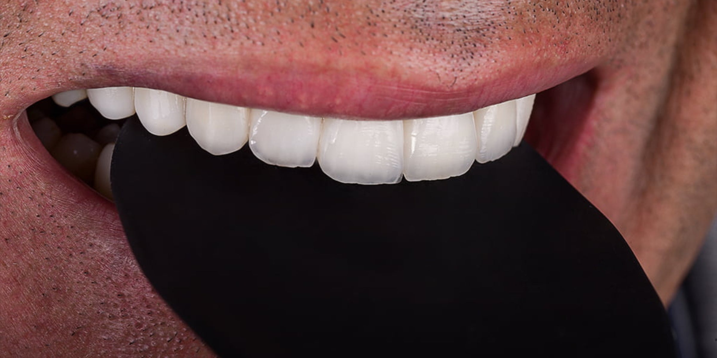 How to Choose and Sterilize Dental Contrasters for Perfect Clinical Photography Dentiphoto