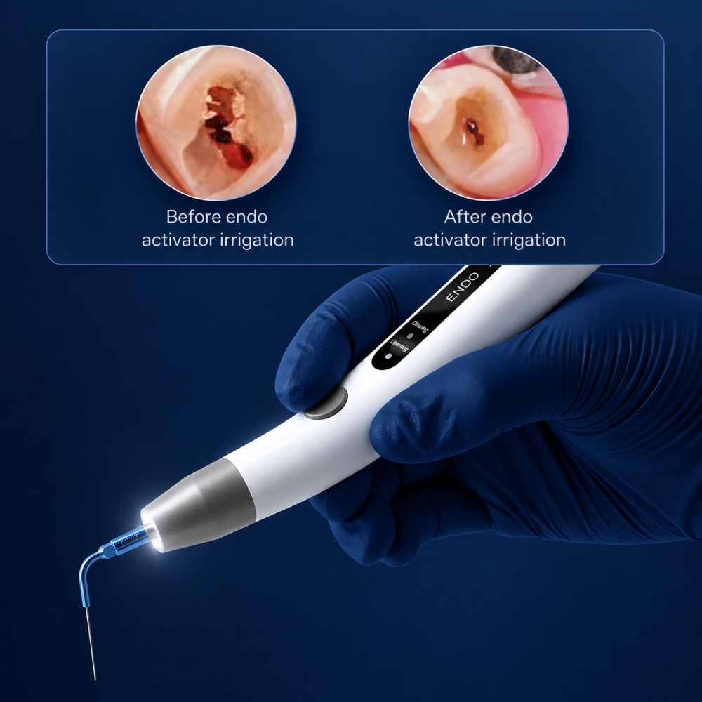 LED Endodontic Irrigation Activator Pro – 360° Illumination & Sonic Root Canal Cleaning