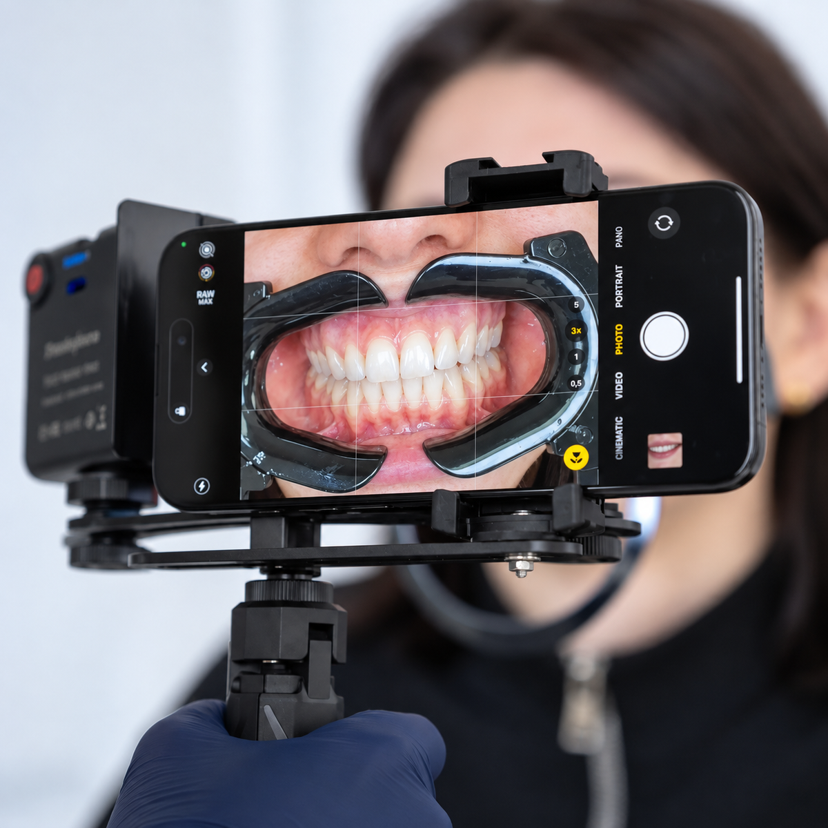 Dentiphoto Twin Light スマートフォン歯科撮影用 — 100 mmマクロレンズ・CPLフィルター付きデュアルLED、USB-C