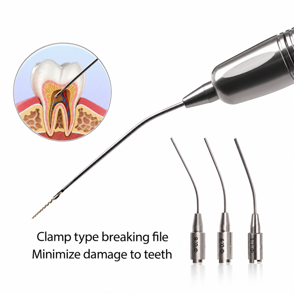 Endo File Removal System – Root Canal Broken File Extractor Kit