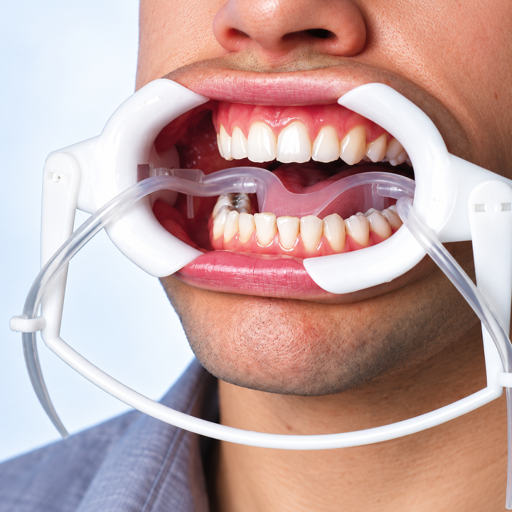 Sistema Retractor NOLA Cheek con Protector Lingual y Set de Cánula de Succión